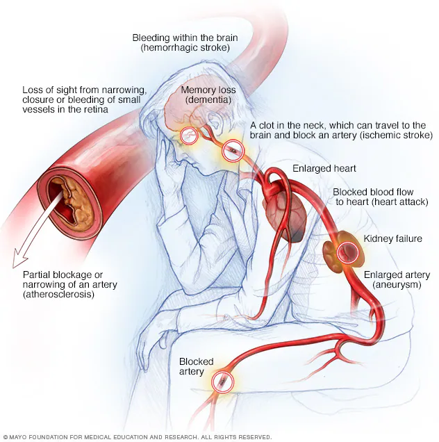 How Valzaar 160 and Amlip 5 Can Help You Live a Better Life if You Have Heart Failure