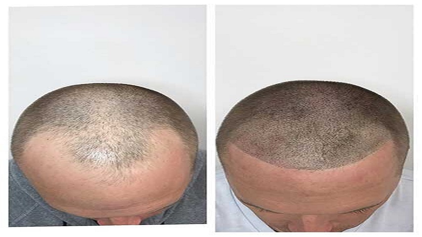  Beyond Aesthetics: The Holistic Importance of Hair Transplants for Women